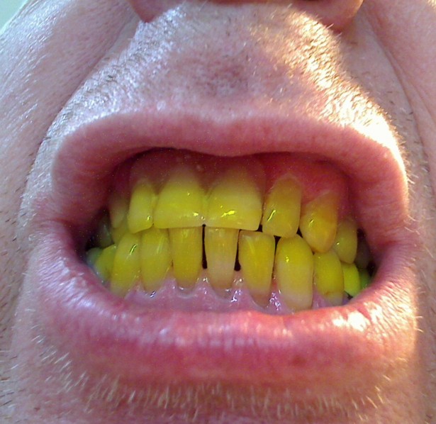 Verfärbungen: 4 Tipps für weißere Zähne ohne sie zu bleichen