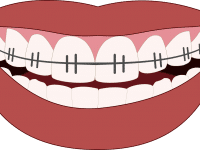 Was tun bei schiefen Zähnen?